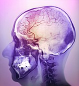 Stroke,angiogram