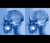 Stroke treatment,angiogram