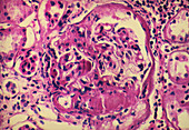 LM of glomerulus in diabetic kidney