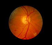 Fundus camera image: mod-severe diabetic retinopty