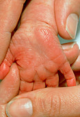 Down's syndrome showing skin creases