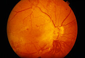 Fundus camera image: prolif. diabetic retinopathy