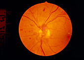 Ophthalmoscopy of eye with diabetic retinopathy