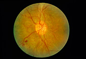 Ophthalmoscopy of diabetic retinopathy after laser