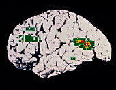 Coloured PET scan of brain showing depression