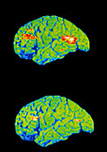 PET scan of depressed and normal brain