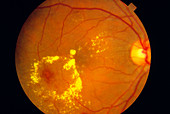 Ophthalmoscopy of diabetic eye with maculopathy