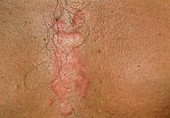Close-up of seborrhoeic dermatitis on the chest