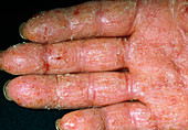 Contact dermatitis