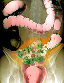 Colon diverticula,X-ray