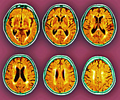 Dementia,MRI scans
