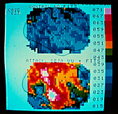 Gamma camera scan of blood flow in the brain