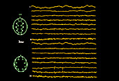 EEG in epilepsy: intermittent focal spikes