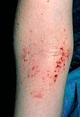 Atopic eczema in crook of the elbow