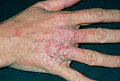 Close-up of eczema on hand (knuckles)