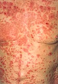 Acute eczema on the torso of alzheimer's patient