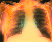 Chest X-ray showing pulmonary emphysema