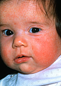 Eczema on baby's face