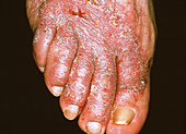 Eczema with fungal infection