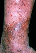 Varicose eczema