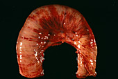 Intestinal enteritis