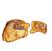 Emphysema of the lungs,CT scan