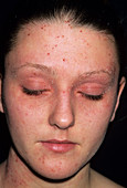 Eczema on a girl's face