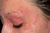 Eczema on a girl's face