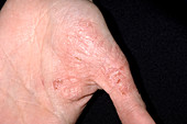Eczema skin condition