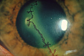 Dendritic ulcer (herpes simplex) on cornea of eye