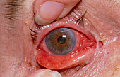 Eye showing conjunctivitis (pink eye)