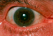 Kayser-Fleisher ring on rim of iris of the eye