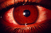 Close-up of eye showing conjucntivitis