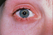 Macrophoto of human eye with blepharitis