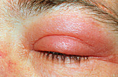 erysipeloid eye infection