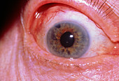 Glaucoma: trabeculectomy mark in iris