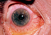 Close-up of an eye with acute iritis