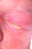 Child's eye affected by conjunctivitis