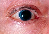 Changes to iris following trabeculectomy