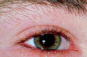 Blepharitis: infection at base of eyelashes