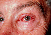 Corneal abrasion,showing reddening of an eye