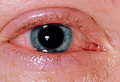 Corneal ulcers due to contact lens wearing