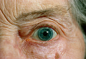 Elderly woman with arcus senilis of the eyes