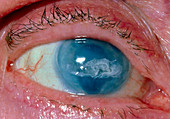 Corneal calcification and scarring after surgery