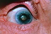 Eye disorders: arcus senilis and cataract