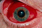 Close-up of eye: sub-conjunctival haemorrhage