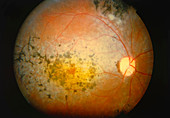 Retinitis pigmentosa: fundus camera image