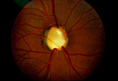 End stage glaucoma: cupping of optic disc