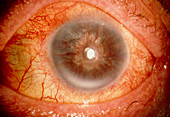 Rubeotic glaucoma: rubeotic glaucoma