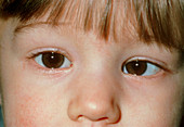 Close-up of child's face with convergent squint